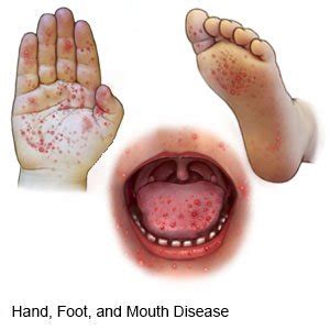 Hand, foot, and mouth disease (hfmd) is a contagious disease that is caused by different viruses. Hand, Foot, and Mouth Disease - What You Need to Know