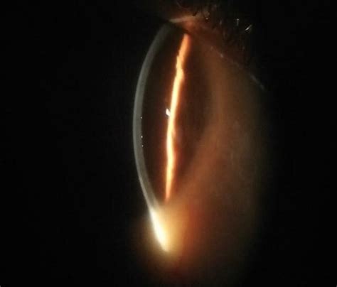 Slit Lamp Image Showing Fine Keratic Precipitates On Back Of Cornea In
