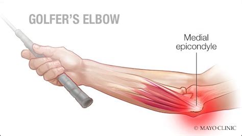 Medial Epicondylitis Aka Golfers Elbow