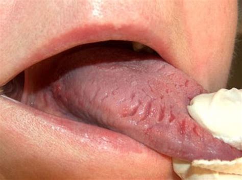 Your Tongue Says A Lot About Your Health Tongue Health Tongue Sores