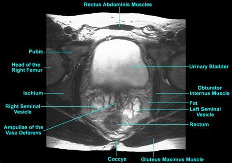 Prostate Anatomy Mri