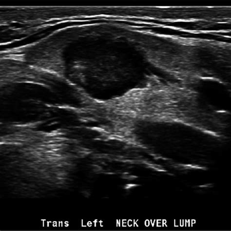Ultrasound Of The Left Submandibular Gland Showing A 16 × 12 × 13