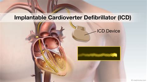 Defibrillator Aicd Implantation Dr Karthigesan