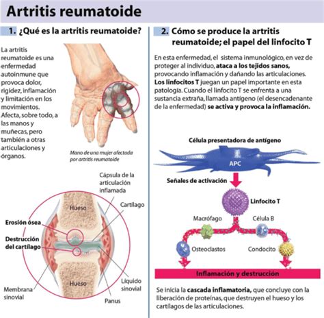 Artritis reumatoide Qué es causas síntomas tratamiento y consejos