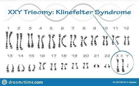 Klinefelter Syndrome Karyotype Vector Illustration Xxy Trisomy Stock Vector Illustration Of