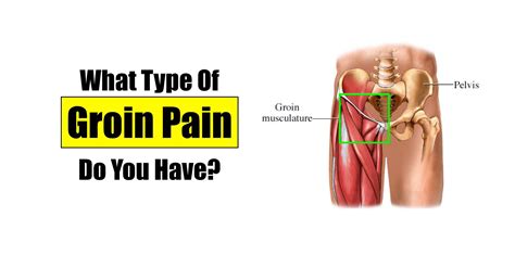 Athletic pubalgia or groin pain in athletes is a clinical syndrome of chronic lower pelvic and groin pain, usually encountered in athletes. Pin on Relief please!