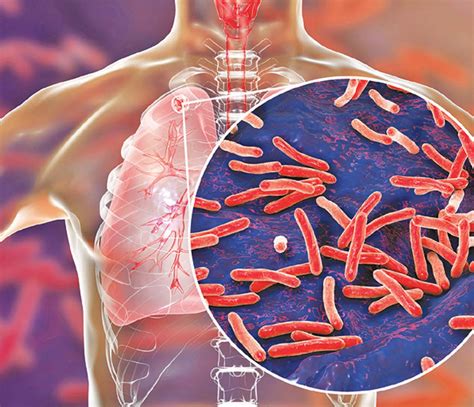 Health Authorities Clueless About Over 31000 Tuberculosis Patients