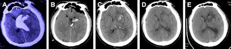 Pre And Post Operation Ct Scans Of An Intraventricular Hemorrhage That