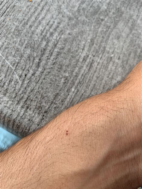 Does This Look Like A Bat Bite Sorry If This Is The Wrong Sub I Just