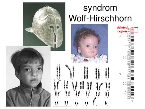 Wolf Hirschhorn Syndrome Adult