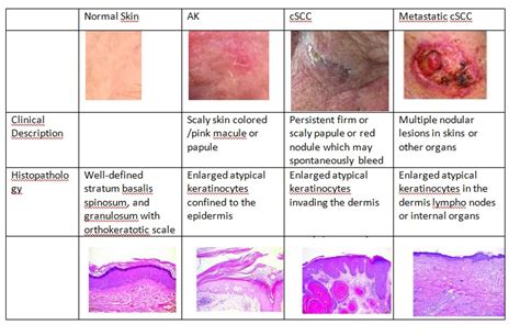 Basal Cell Carcinoma Vs Squamous Cell Carcinoma Histology