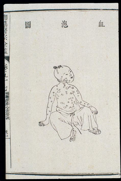Chinese C18 Paediatric Pox Blood Blister Pox Wellcome Collection
