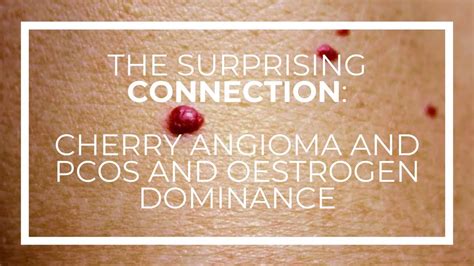 The Surprising Connection Between Cherry Angioma And Pcos And Oestrogen
