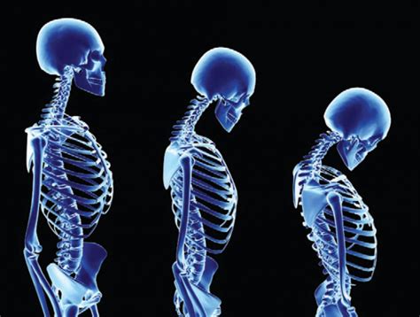 What Are Osteoporosis Symptoms Clevertopic