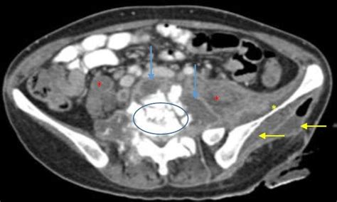 B A Contrast Enhanced Computed Tomography Cect Scan Of The Abdomen