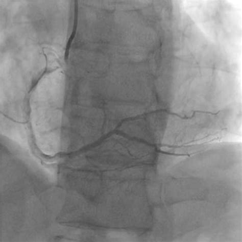 Post Procedure Severely Calcified Right Coronary Artery CSI