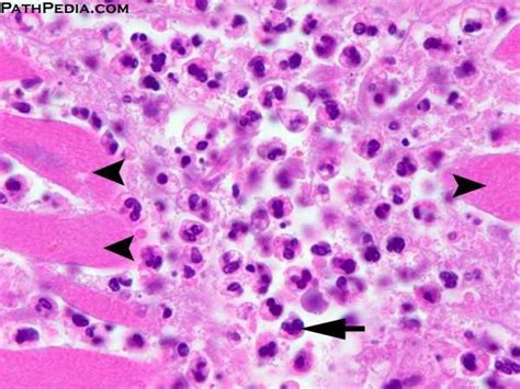 Histological evaluation of biopsies was initially done according to the dallas criteria.2 the presence of an inammatory inltrate. Histopathology images of Myocardial infarction (AMI) by ...
