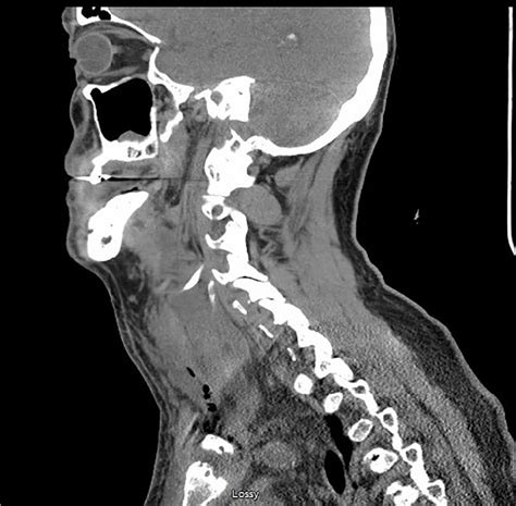 Computed Tomography Neck Without Contrast Sagittal View Showing Right