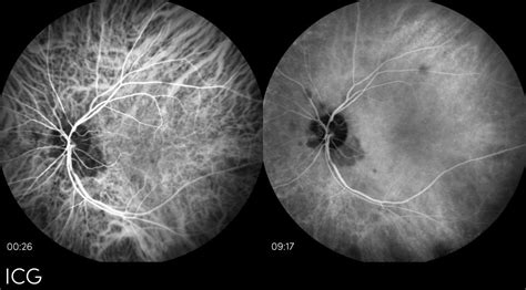 Moran Core Fundus Photography Fluorescein Angiography And