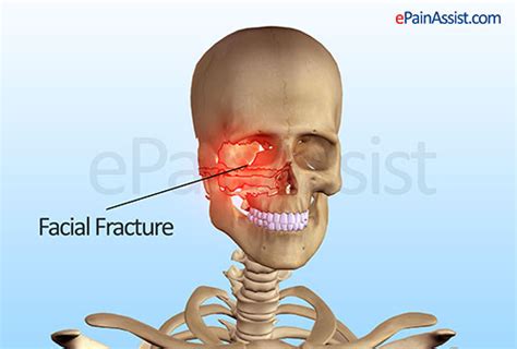 Facial Fracture Signs Classification Types