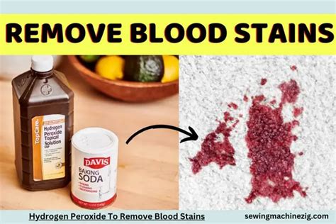 Hydrogen Peroxide To Remove Blood Stains 2023 Sewingmachinezig