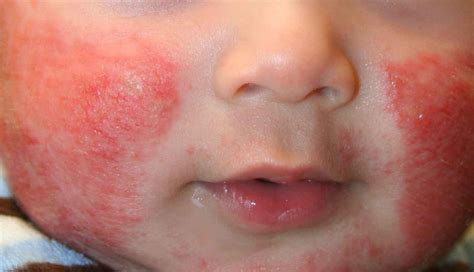 Common Skin Rashes In Babies