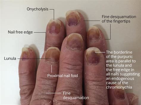 Nails With Bloodstained Discoloration The Bmj