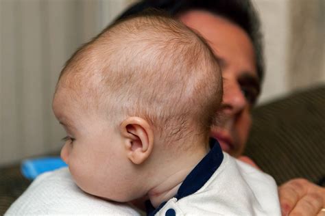 Baby Has Fused Skull Bones What You Should Know About Craniosynostosis