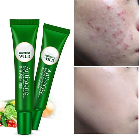 Net Skin Rejuvenation Acne Cream Mild Anti Acne Moisturizing Oil