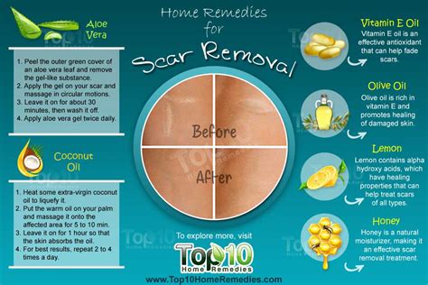 Home Remedies For Scar Removal Top 10 Home Remedies