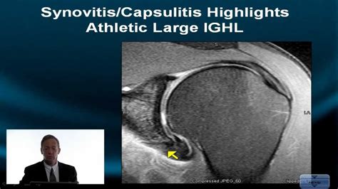 Shoulder Mri Instability Part Ii How To Deal With Variation Axillary