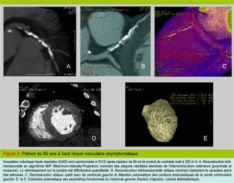 Angiographie Non Invasive Des Coronaires En Scanner Multibarrette