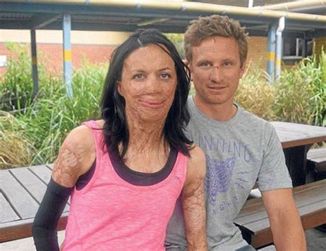 Incredible Story Of Bushfire Survivor Turia Pitt Michael Hoskin Will Restore Your Faith In