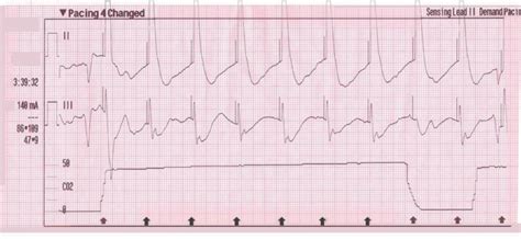 Transcutaneous Pacing Tcp With And Without Capture Acls Medical