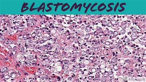 Blastomycosis Histology