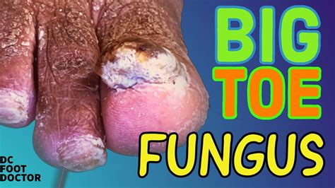Big Toe Fungus Trimming Severely Fungal Toenails YouTube