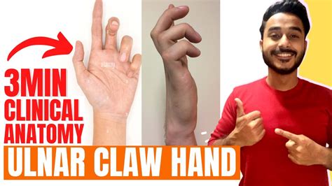 Ulnar Claw Hand Clinical Anatomy Of Ulnar Nerve Ulnar Nerve Clinical