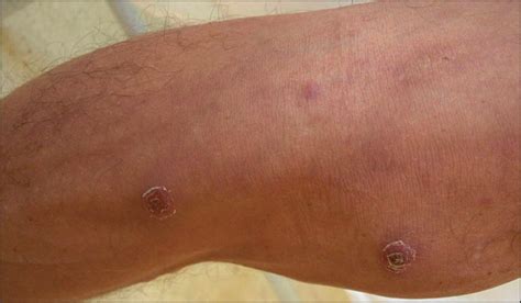 Generalized Ulcerated Nodules In A Patient With Human Immunodeficiency