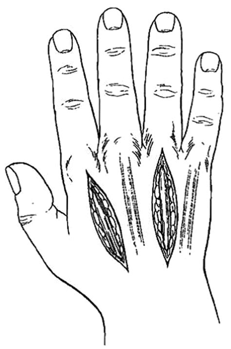 Illustration Demonstrating Two Longitudinal Incisions Made Over The 2nd