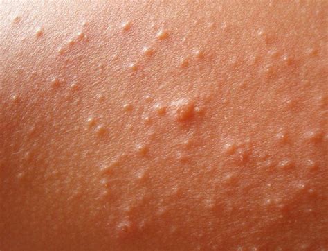 Heat Rash Pictures Symptoms Causes Treatment Home Remedies Hubpages