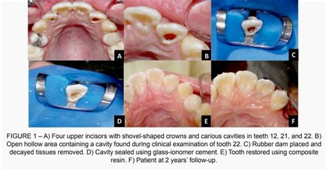 Pdf Conservative Treatment Of Shovel Shaped Upper Incisors And Dens