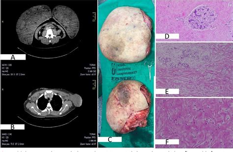 [pdf] pseudoangiomatous stromal hyperplasia of the breast presenting as gigantomastia case