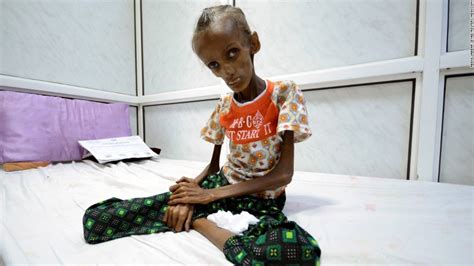 In Yemen A Child Dies Every 10 Minutes Because Of Malnutrition