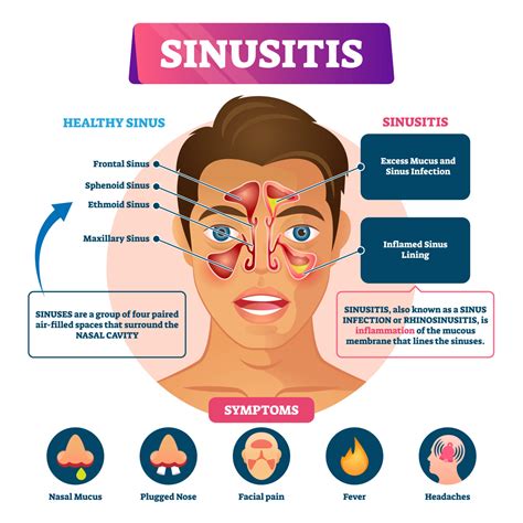 is sinusitis always a chronic condition maryland ent