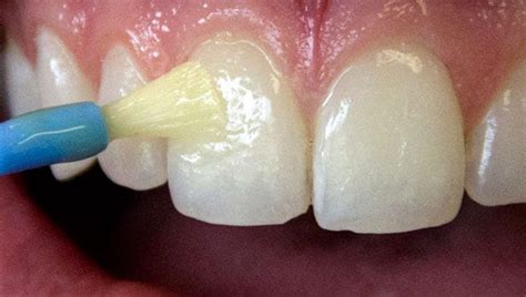 Fluoride Treatments Muskegon Dentist Lumbertown Dental