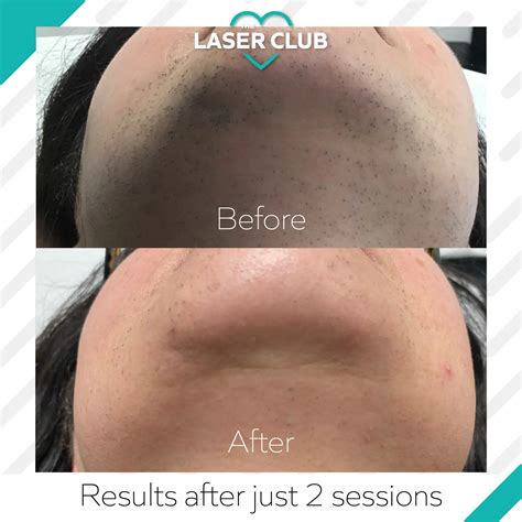 Hirsutism Causes Excess Hair Growth Treatment Laser Hair Removal Hot