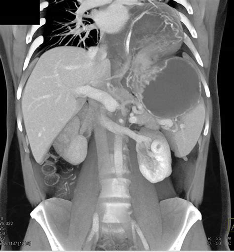 Large Hiatal Hernia With Gastric Volvulus Stomach Case Studies