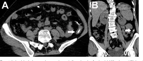 Figure 1 From Bowel Perforation After Ventriculoperitoneal Shunt Placement Case Report And