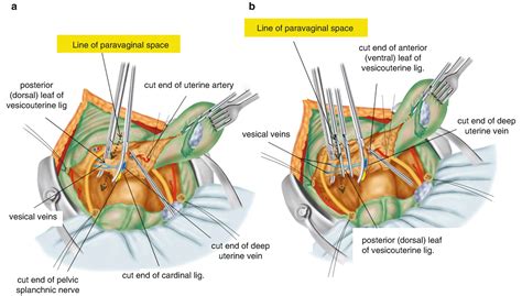 Cardinal Ligament Anatomy