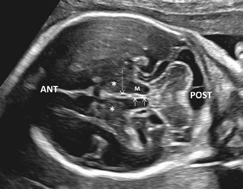 E Normal Aqueduct In A Fetus At 26 Weeks Gestation Oblique Axial